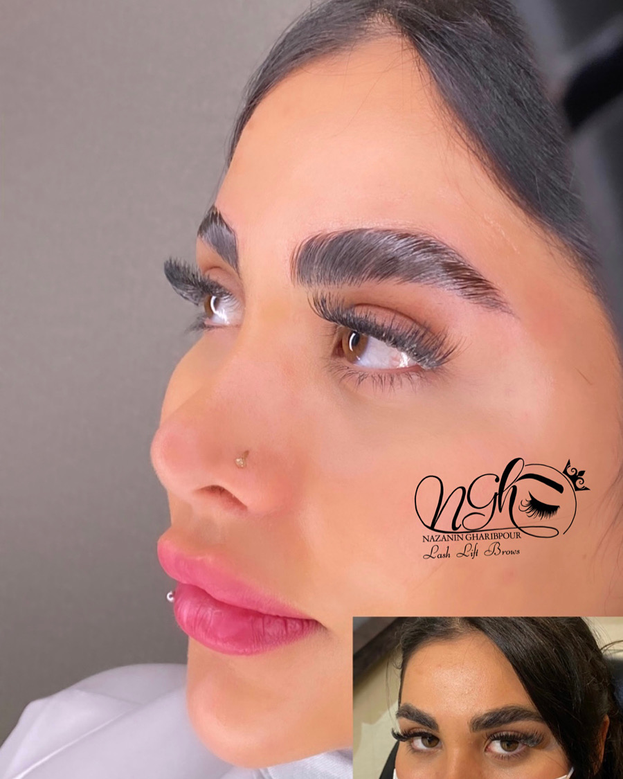 لیفت و بوتاکس ابرو